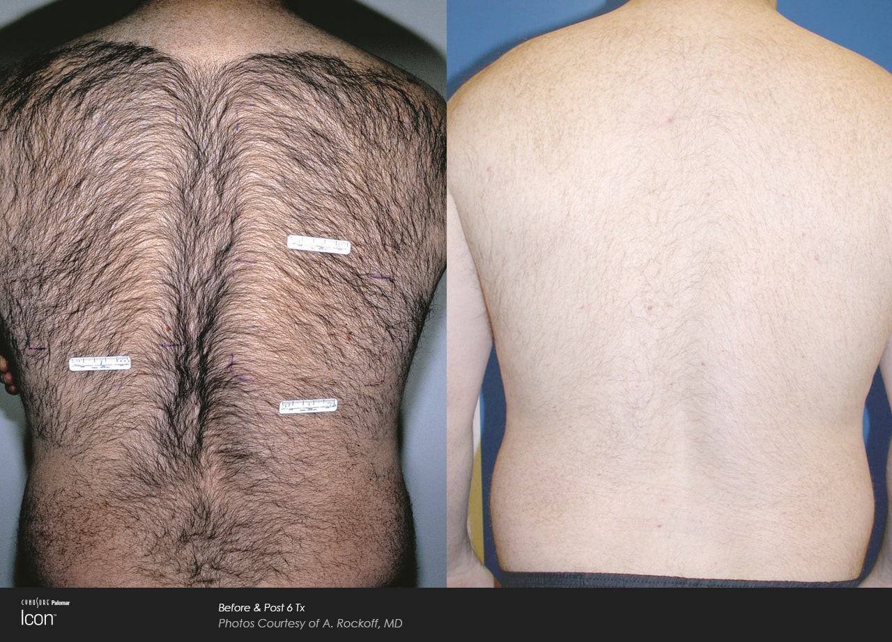 Hair-Removal-Before-26-After-Photo-1