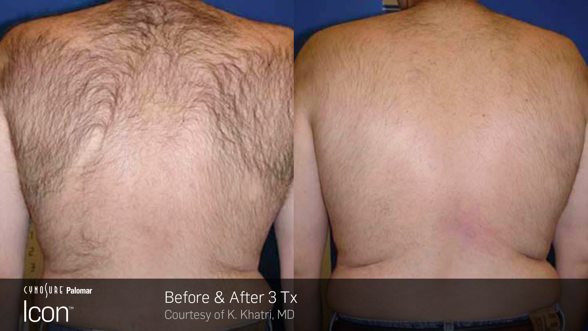Hair-Removal-Before-26-After-Photo-5