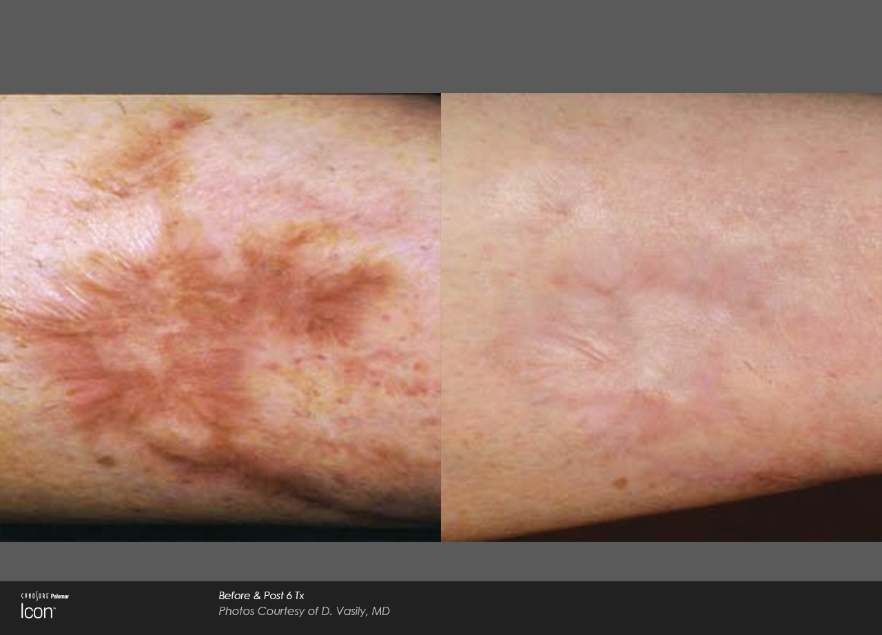 Scar-Removal-Before-and-After-Images-4